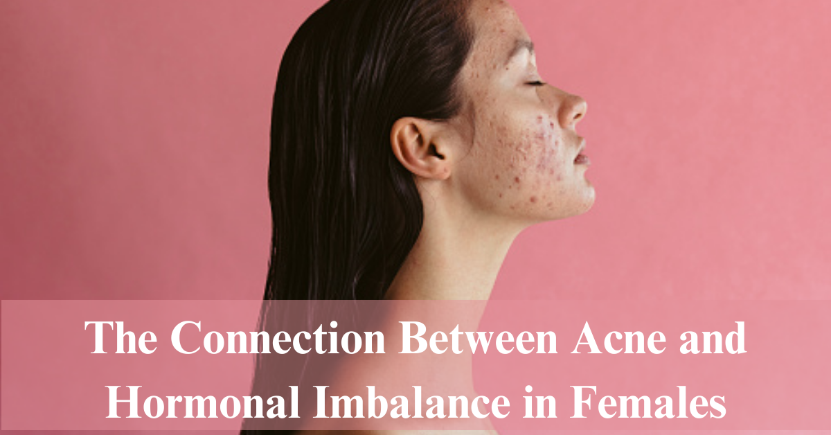 The-Connection-Between-Acne-and-Hormonal-Imbalance-in-Females